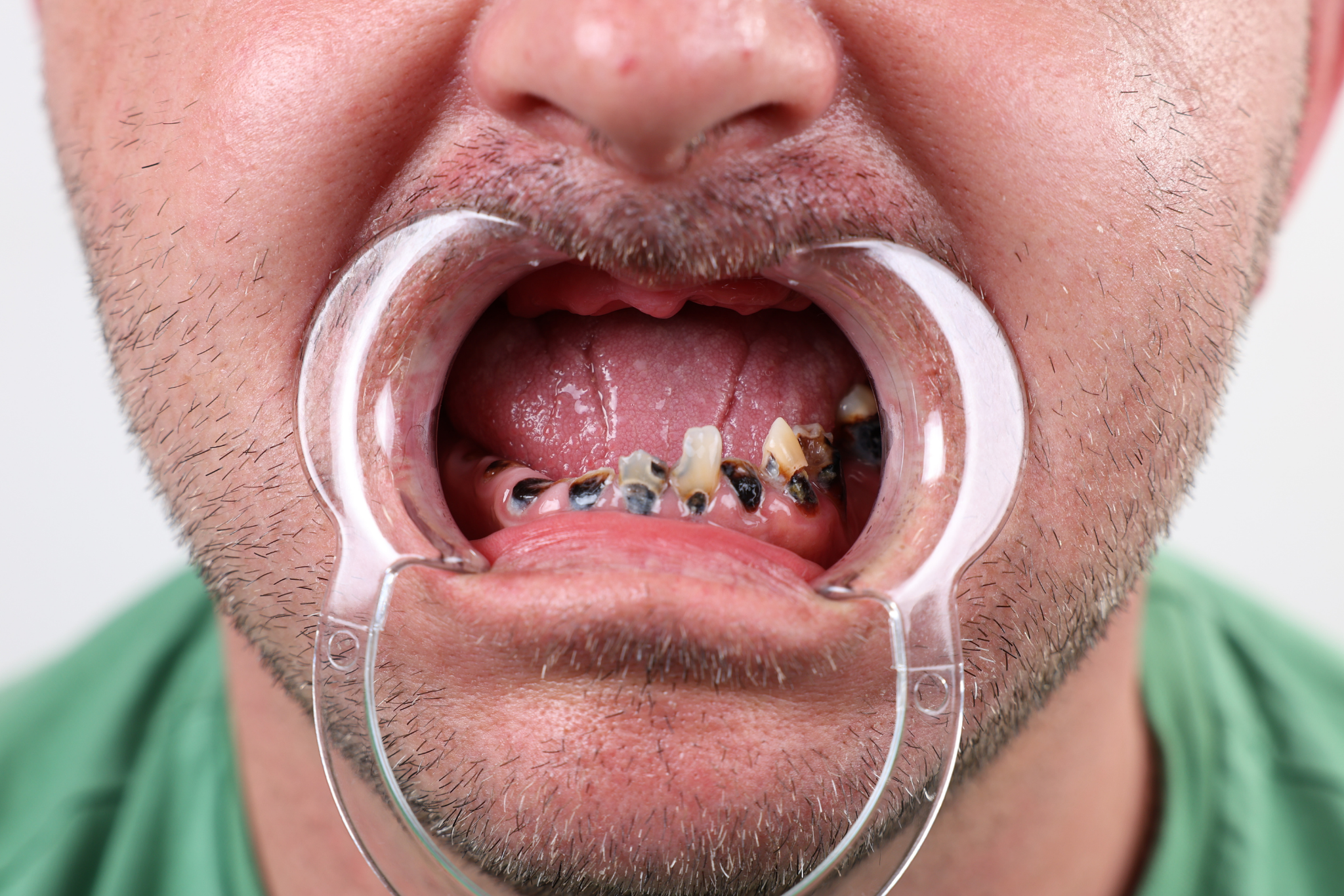 Before All-on-6 Implant Treatment